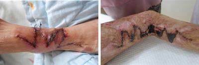 Testing the circulation of expanded flaps—prevention of necrosis of expanded flaps (a clinic study)